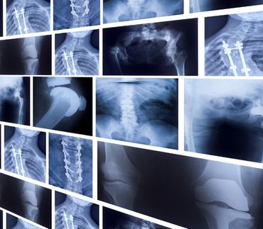 X-ray Scrap